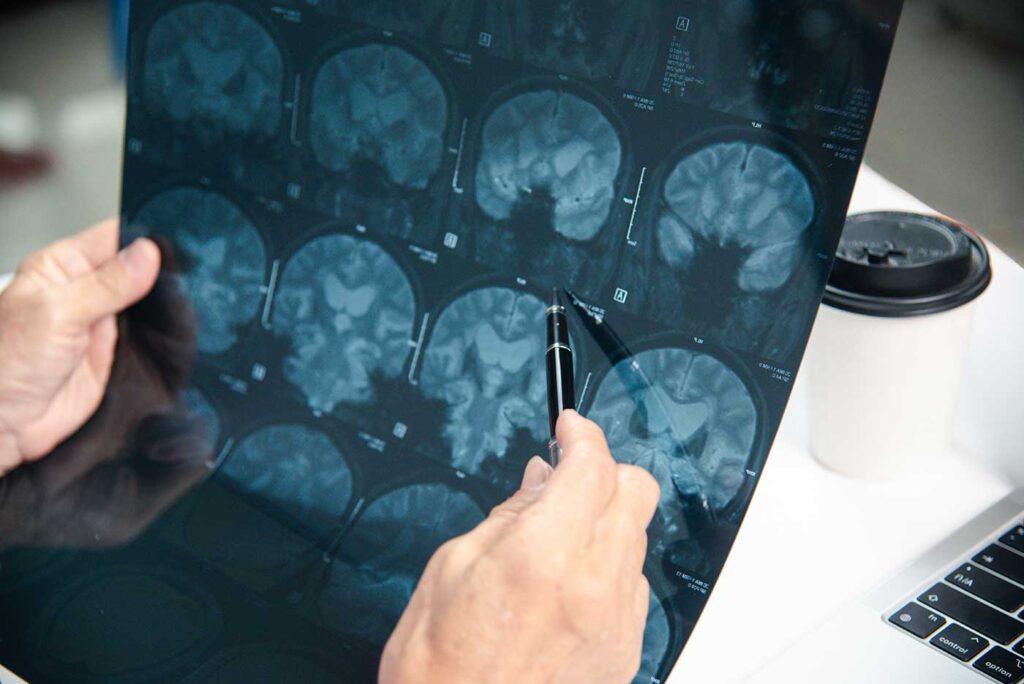 Brain Injury